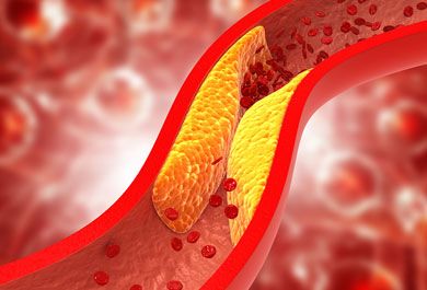 Aktuelles Lipidmanagement: Ein Update