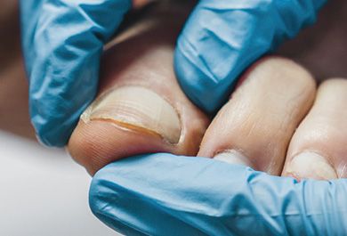 Diagnose und Therapie der Onychomykose